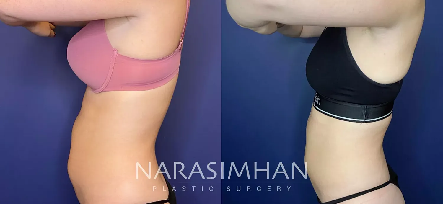 Coolsculpting Before & After