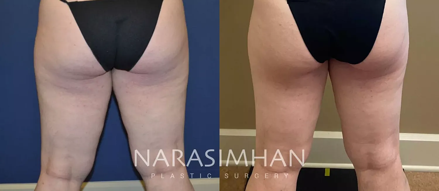 Coolsculpting Before & After