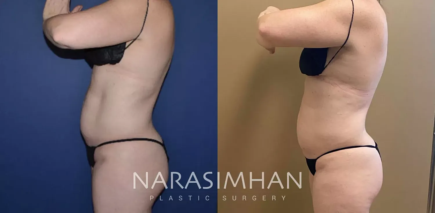 Coolsculpting Before & After