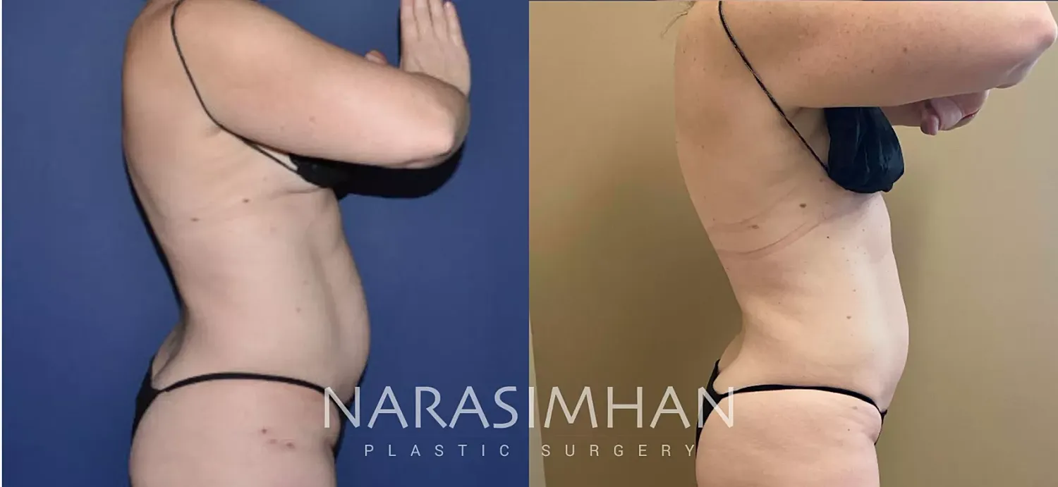 Coolsculpting Before & After