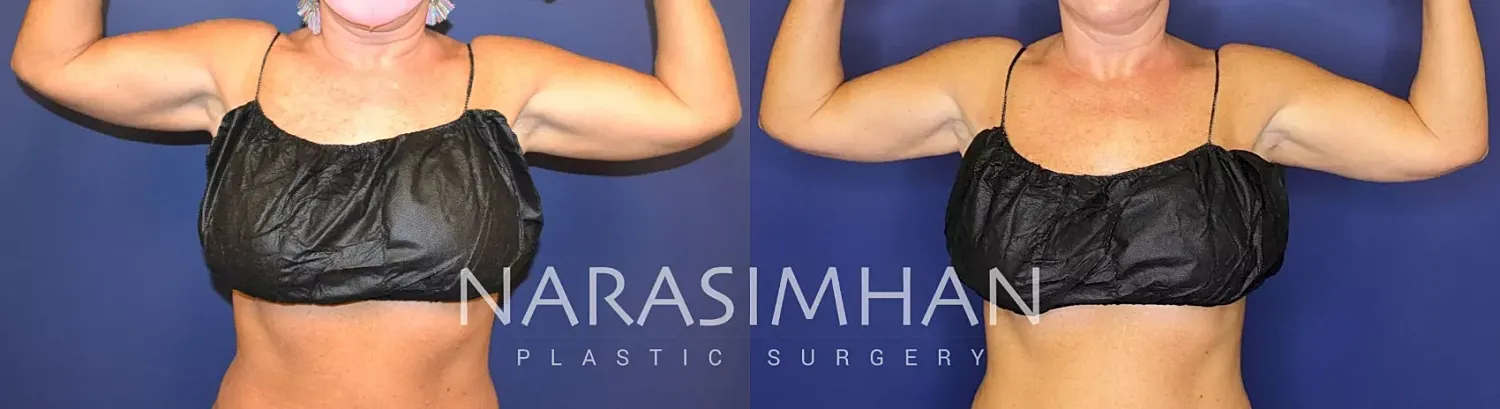 Coolsculpting Before & After