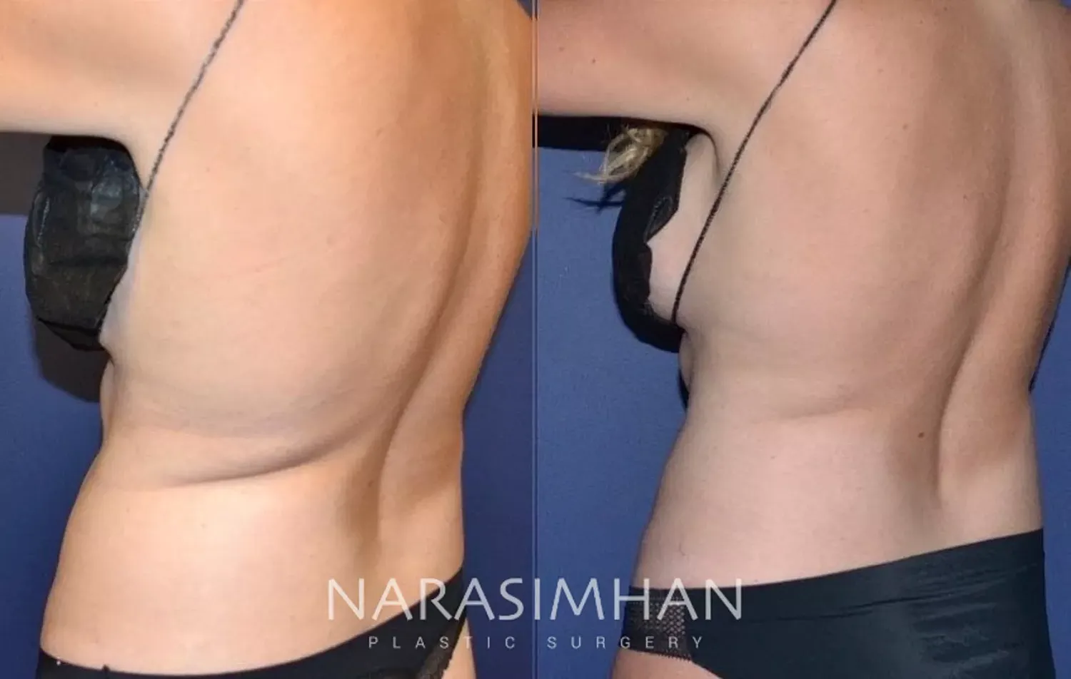 Coolsculpting Before & After