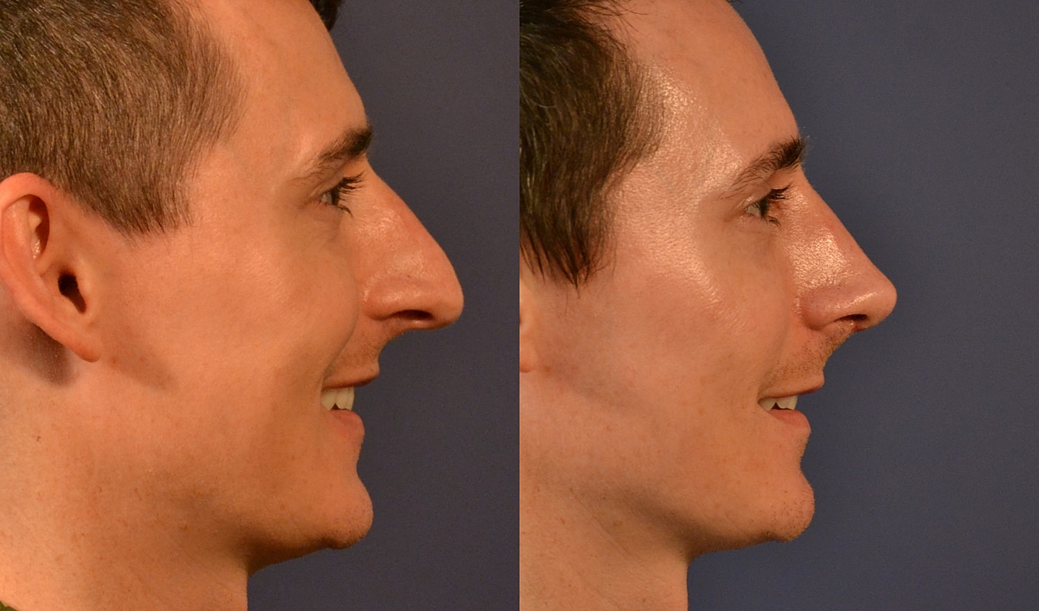 Rhinoplasty Before & After