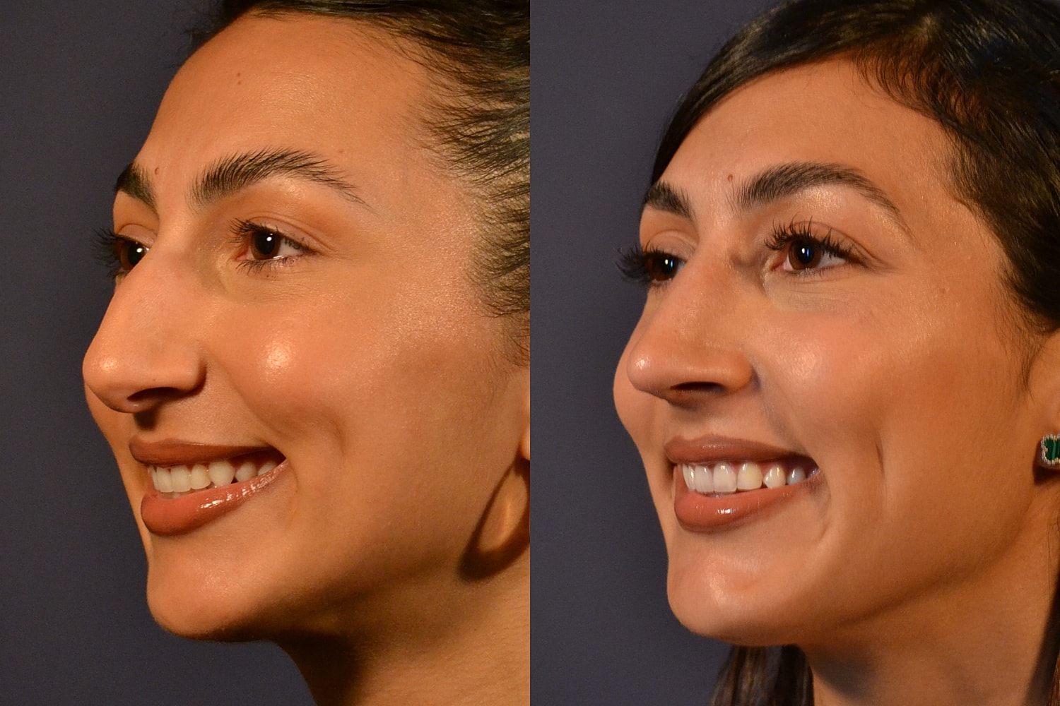 Profile comparison of a woman smiling.