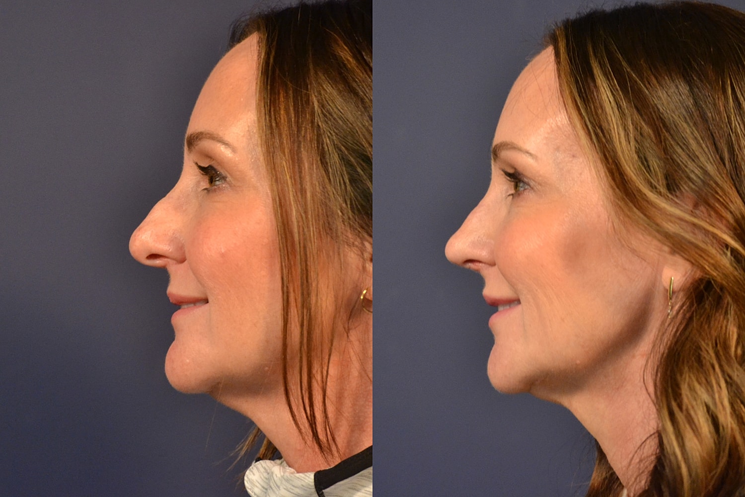 Rhinoplasty Before & After