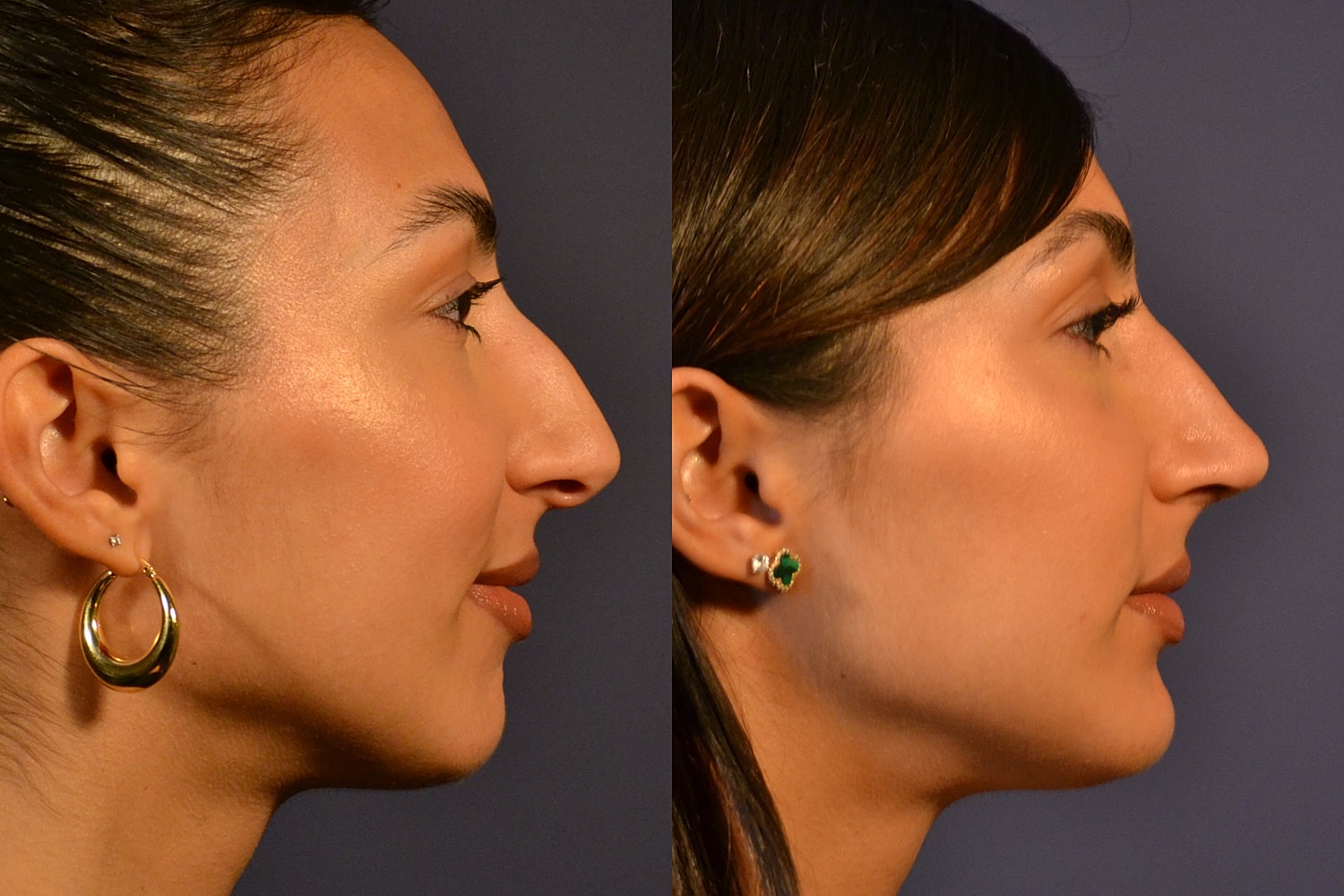 Side profile comparison of two women.