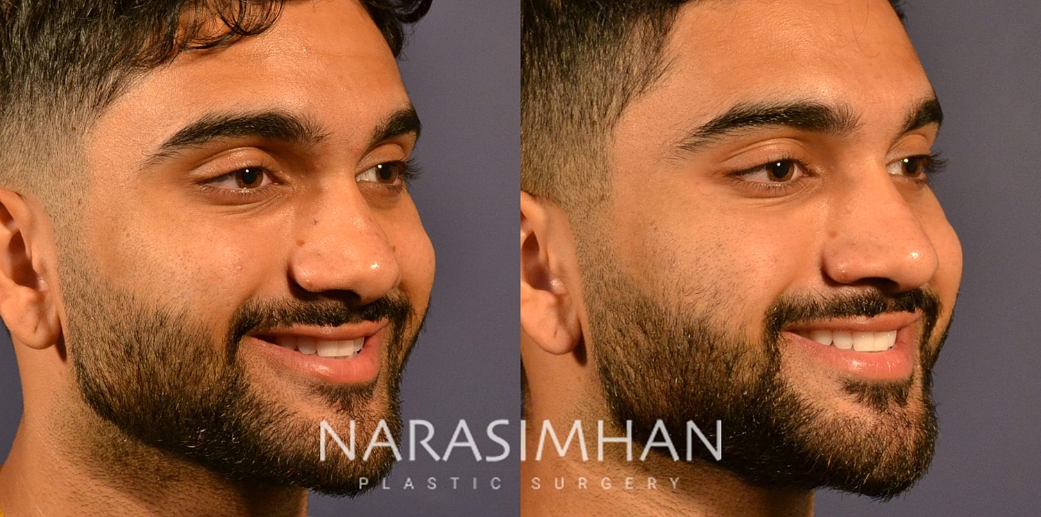 Rhinoplasty Before & After