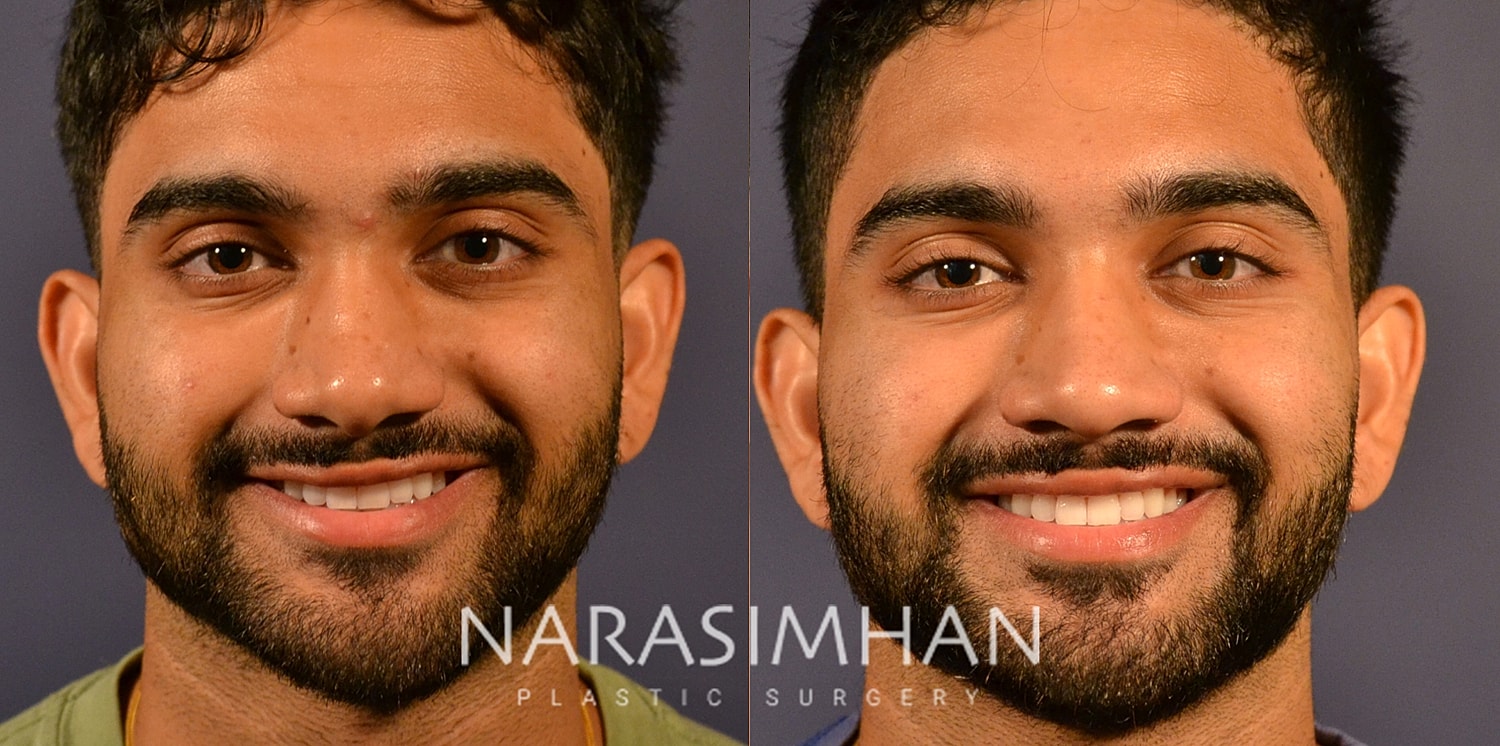 Rhinoplasty Before & After