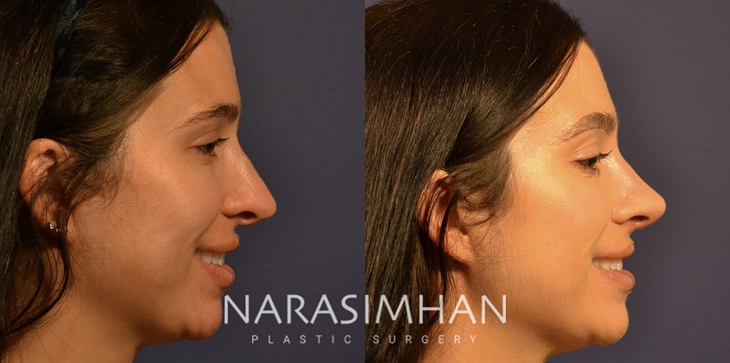 Rhinoplasty Before & After