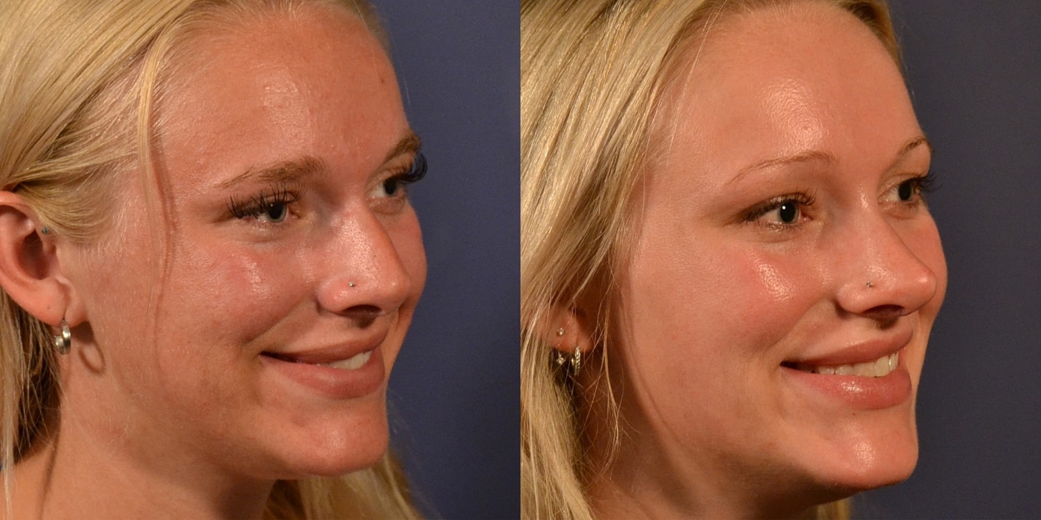 Rhinoplasty Before & After