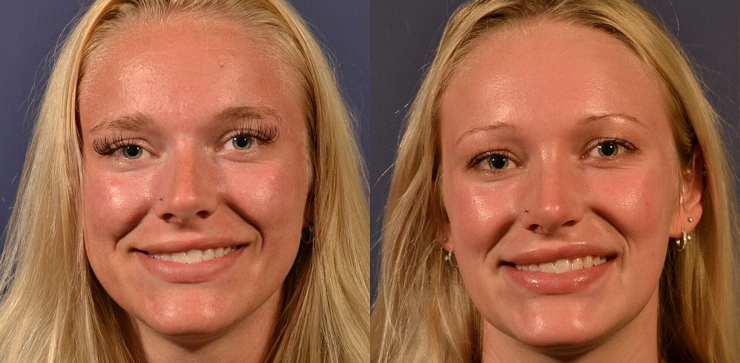Rhinoplasty Before & After