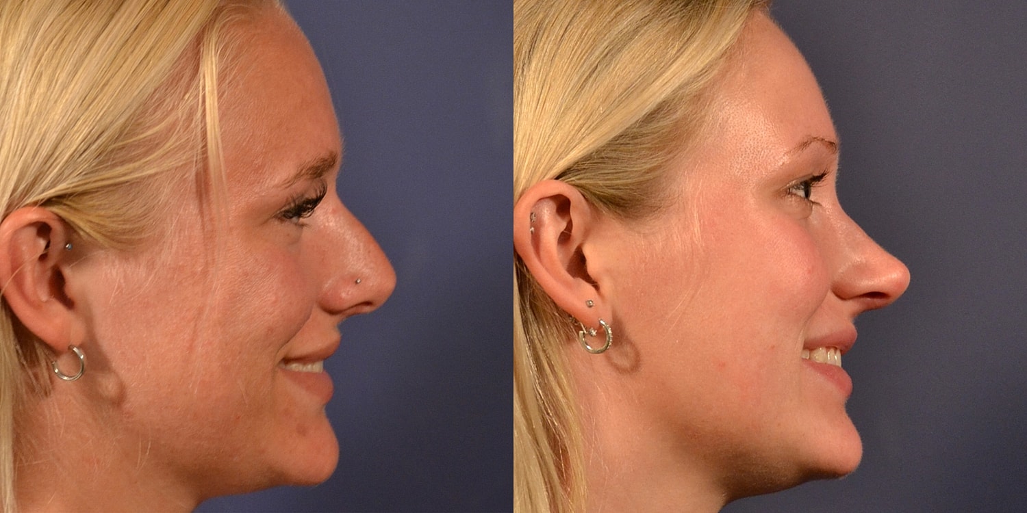 Rhinoplasty Before & After