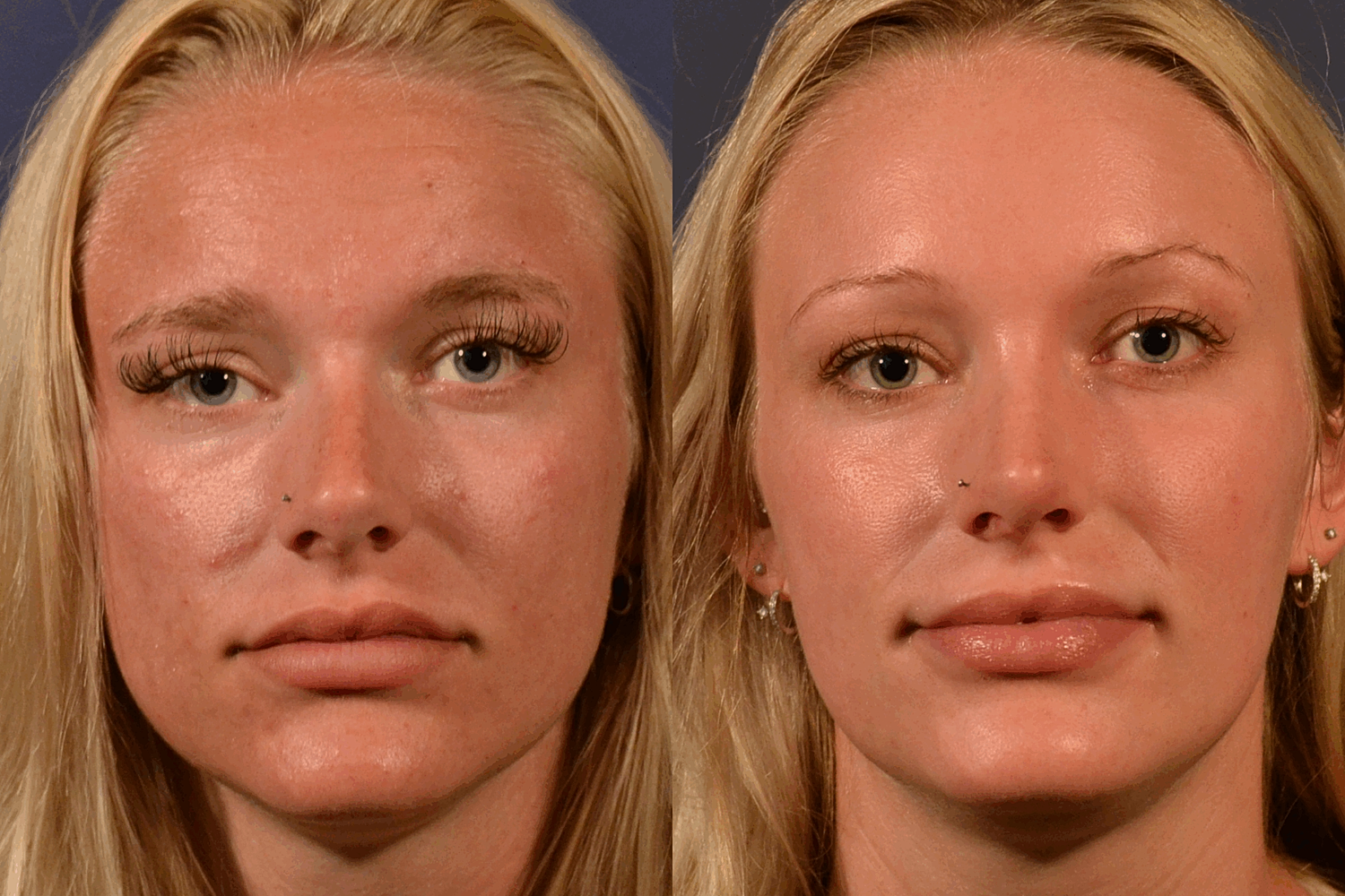 Rhinoplasty Before & After