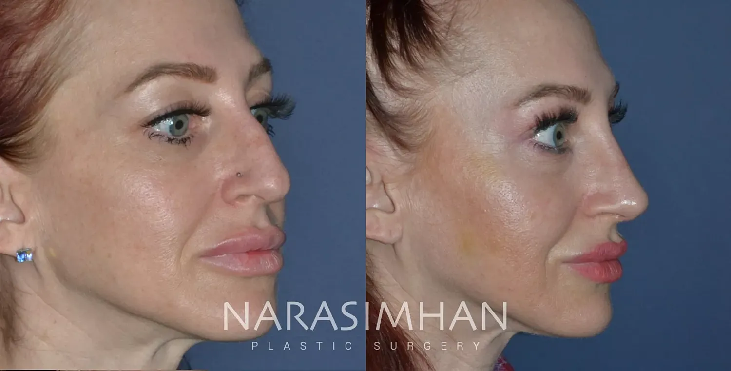 Rhinoplasty Before & After