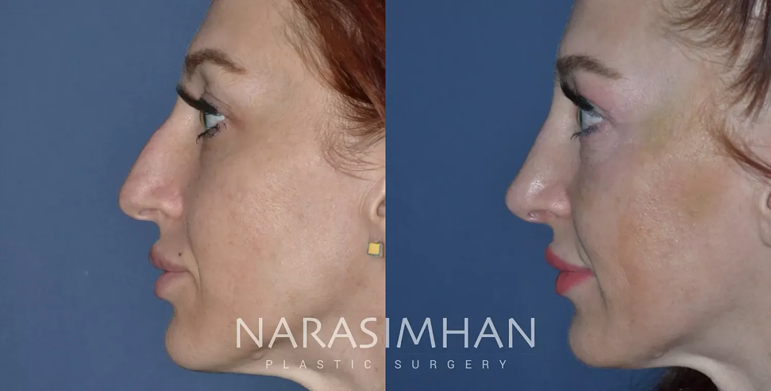 Rhinoplasty Before & After