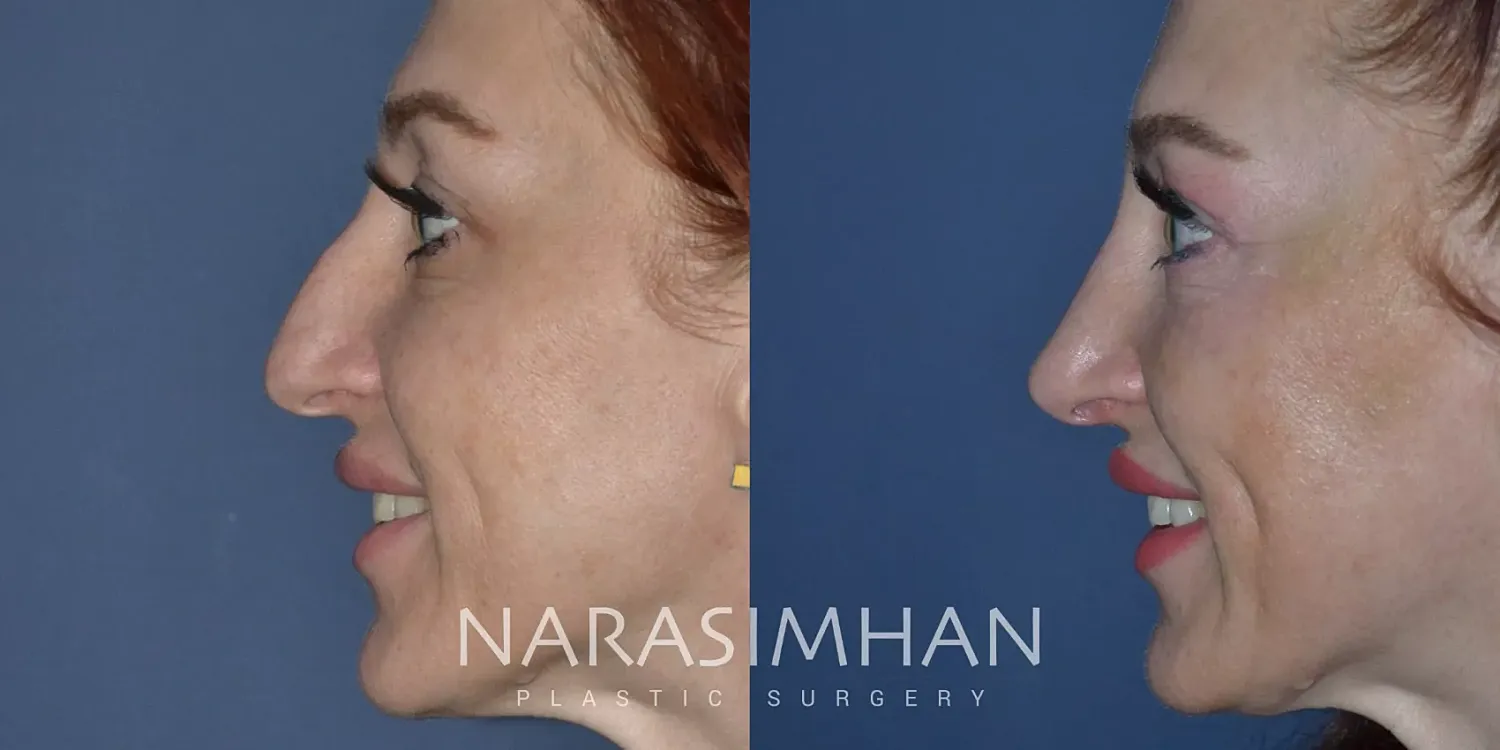 Rhinoplasty Before & After