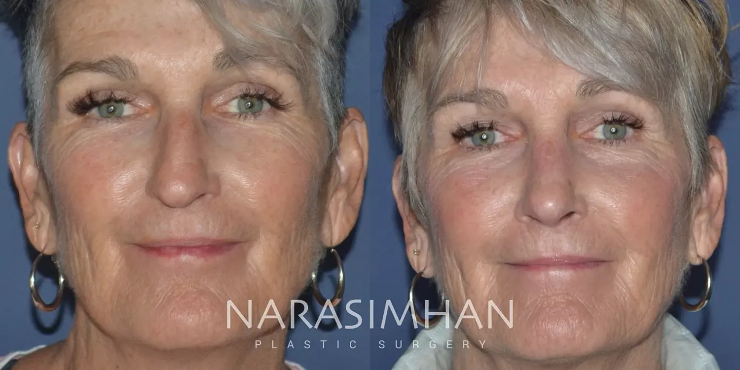 Rhinoplasty Before & After