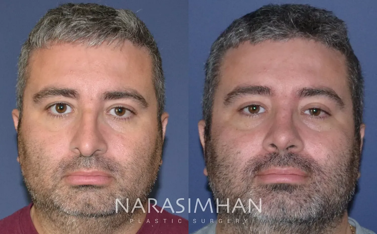 Rhinoplasty Before & After