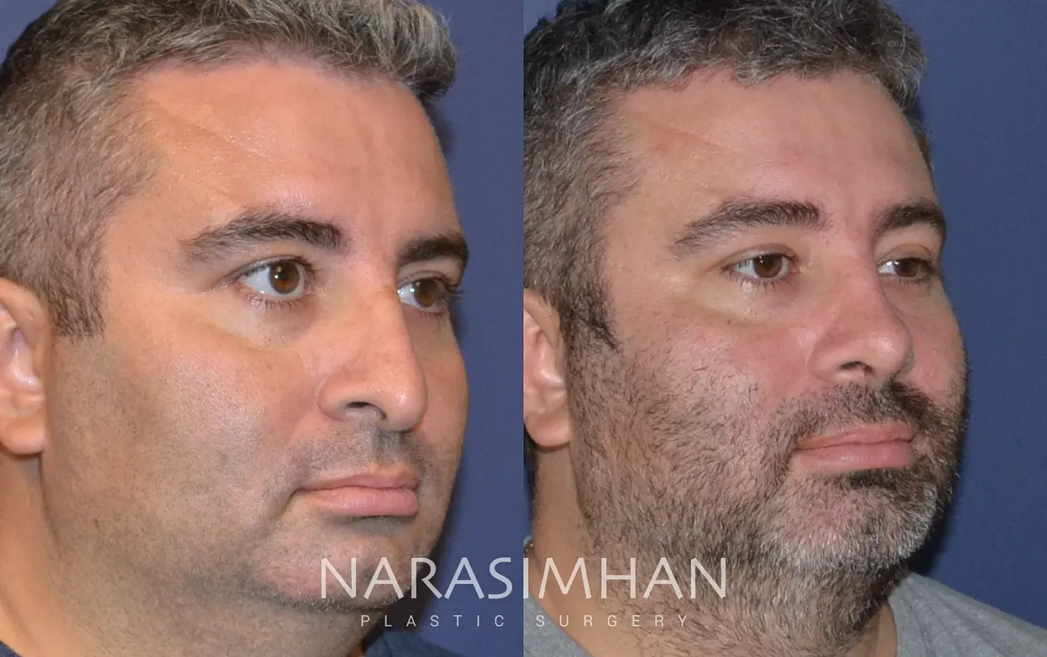 Rhinoplasty Before & After
