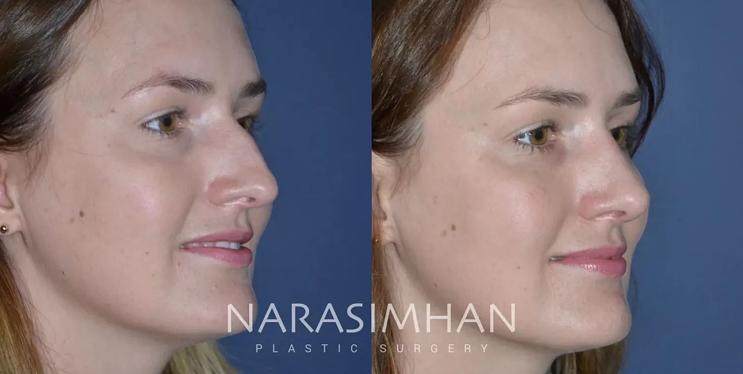 Rhinoplasty Before & After