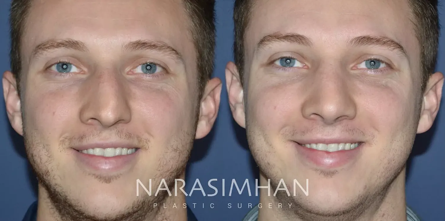 Rhinoplasty Before & After