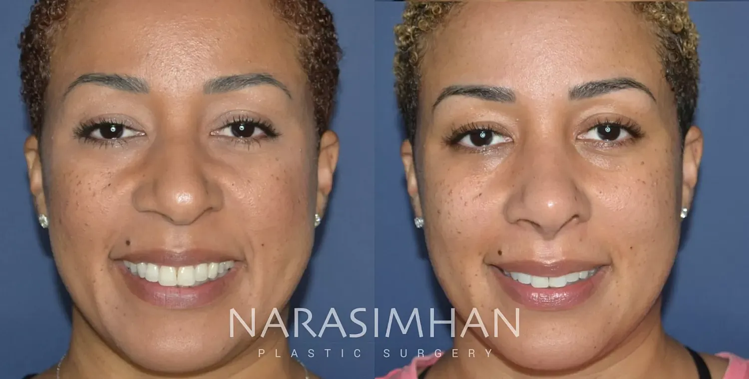 Rhinoplasty Before & After