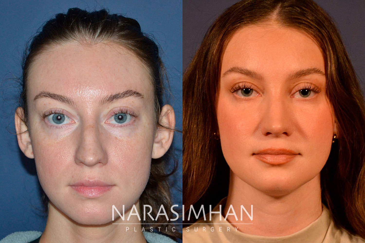 Rhinoplasty Before & After