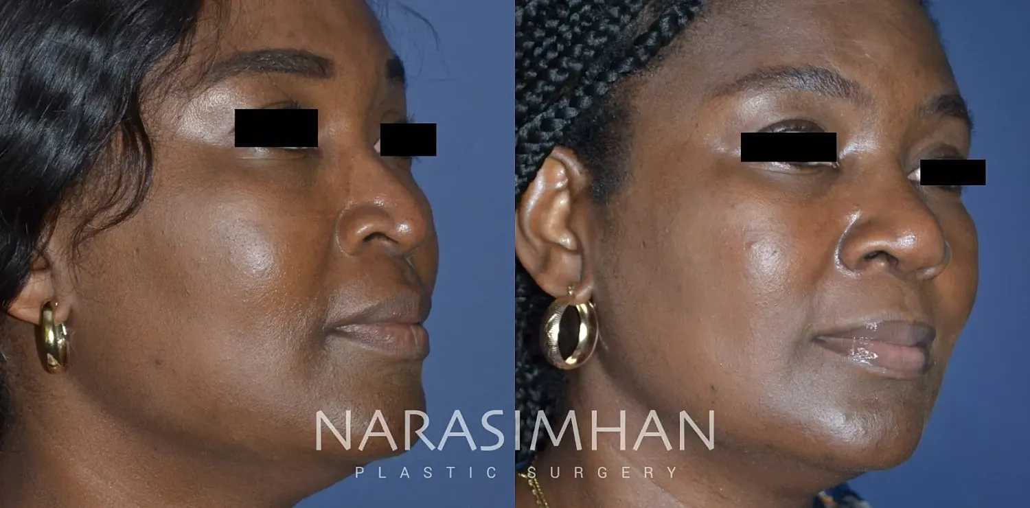 Rhinoplasty Before & After