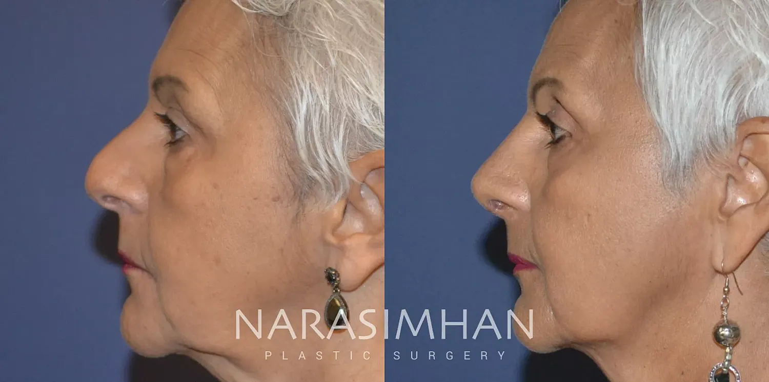Rhinoplasty Before & After