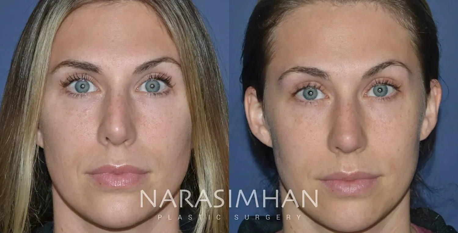 Rhinoplasty Before & After