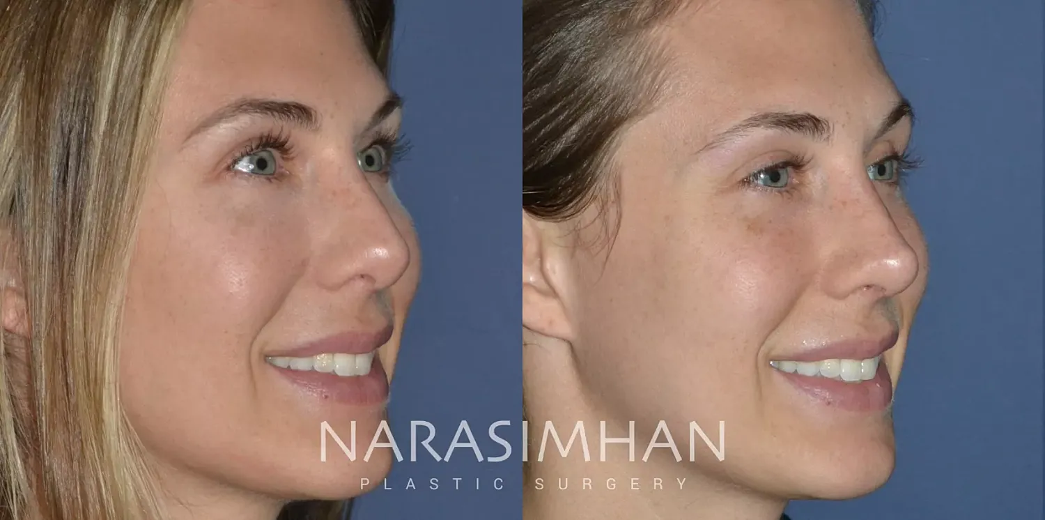 Rhinoplasty Before & After