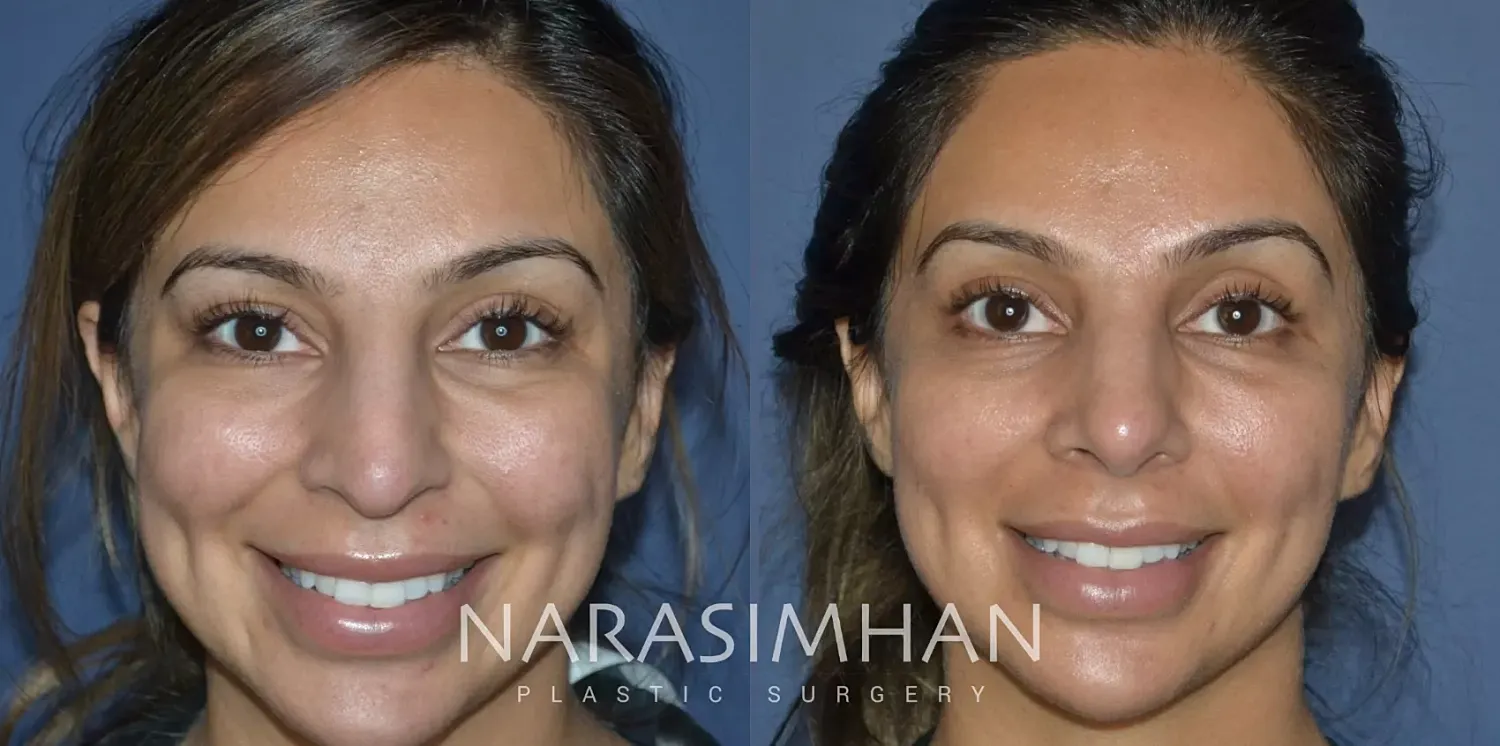 Rhinoplasty Before & After