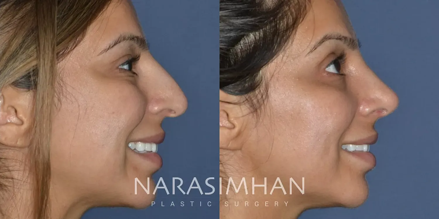 Rhinoplasty Before & After