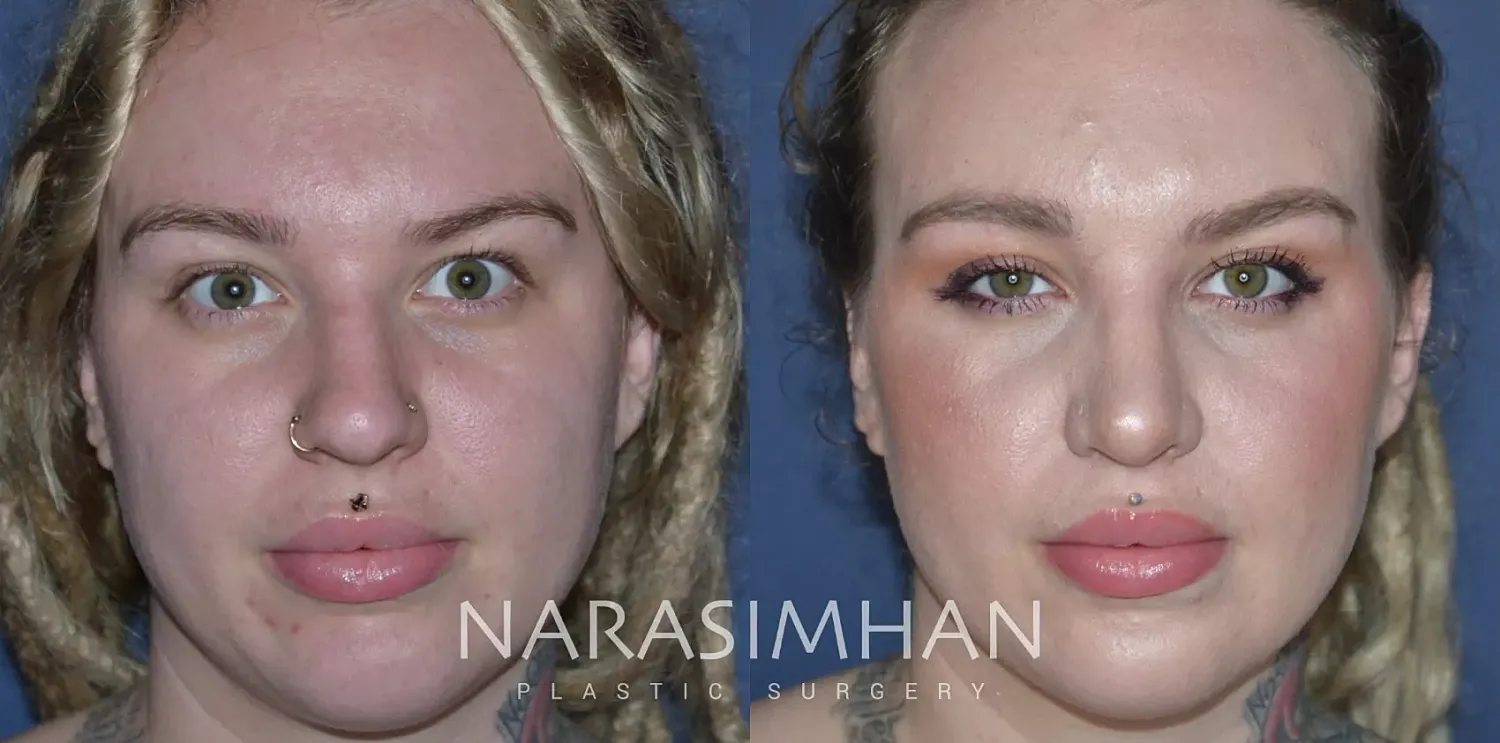 Rhinoplasty Before & After