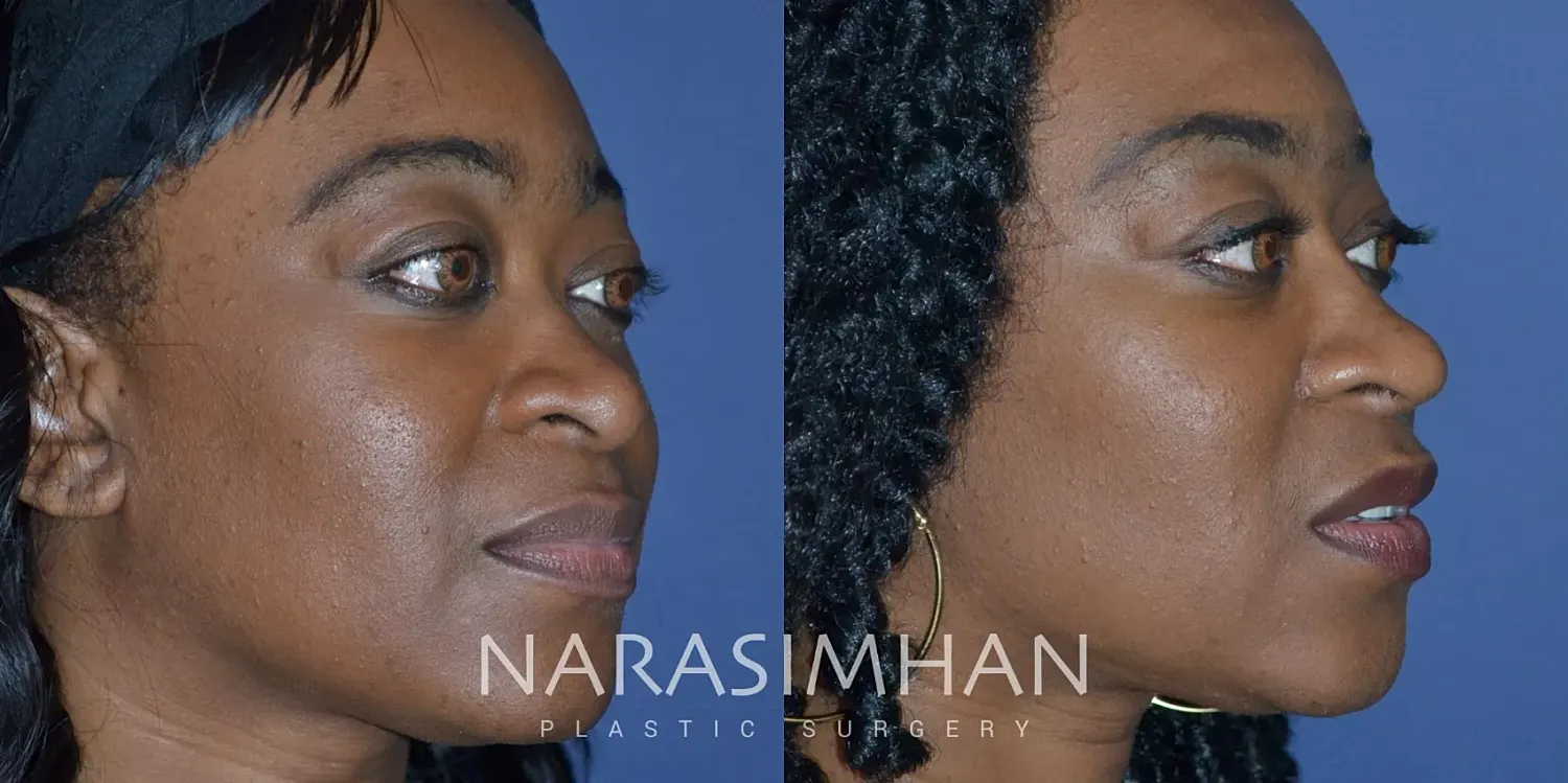 Rhinoplasty Before & After