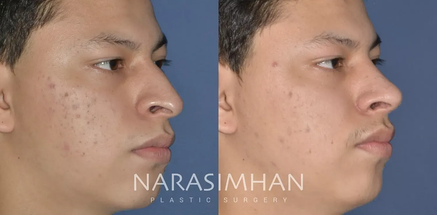 Rhinoplasty Before & After