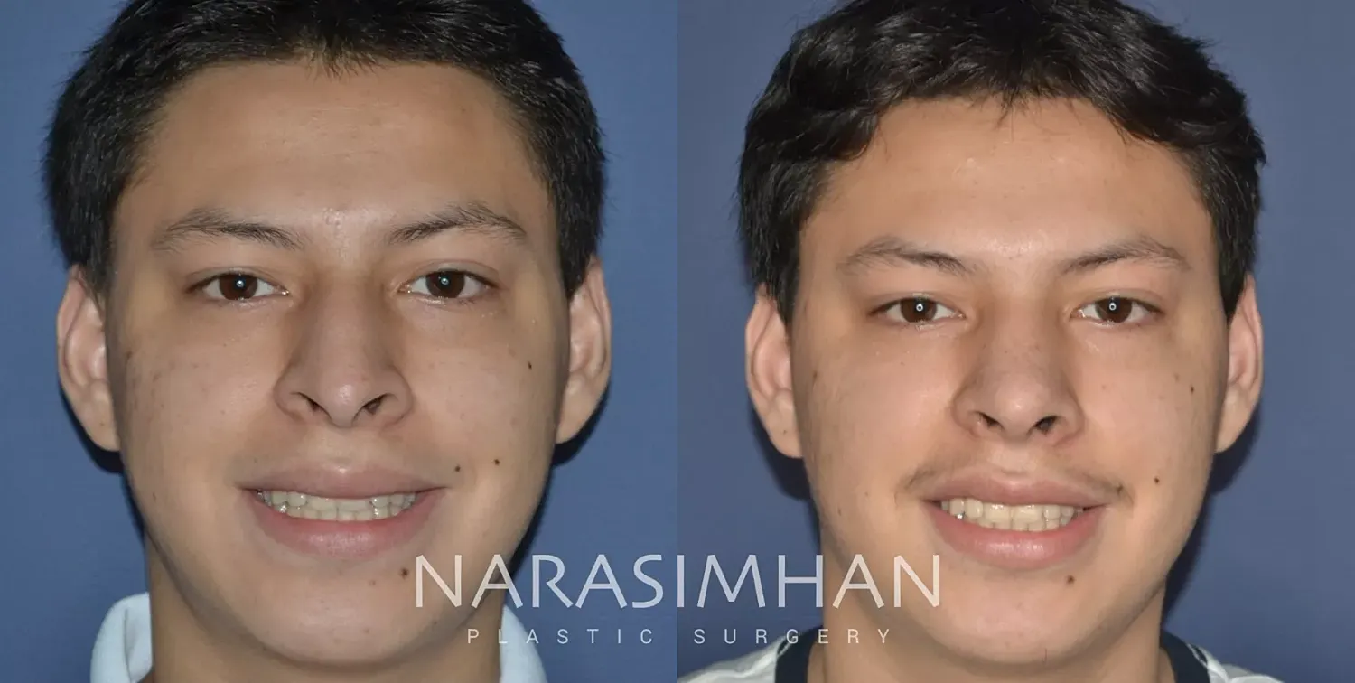 Rhinoplasty Before & After