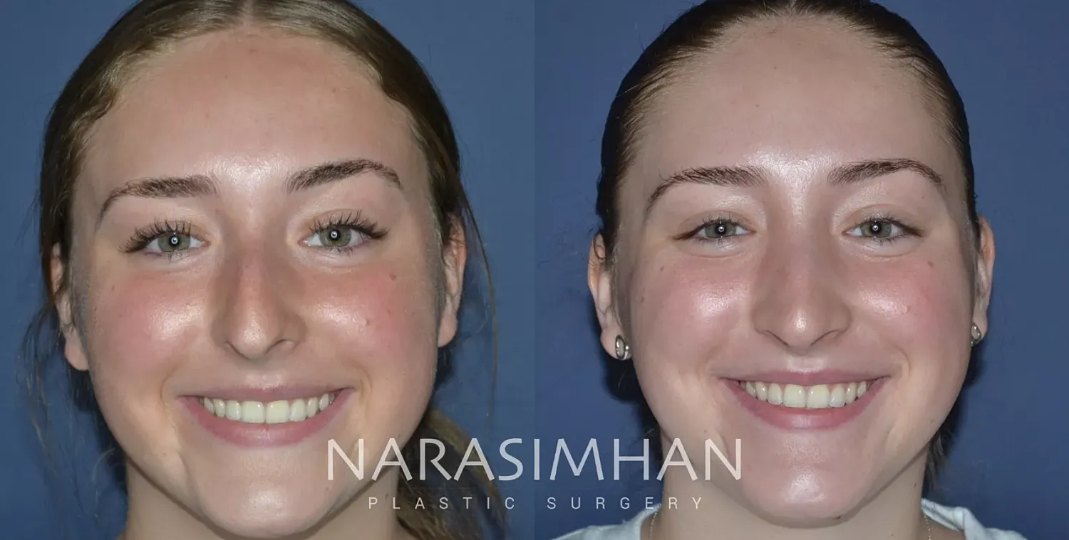 Rhinoplasty Before & After