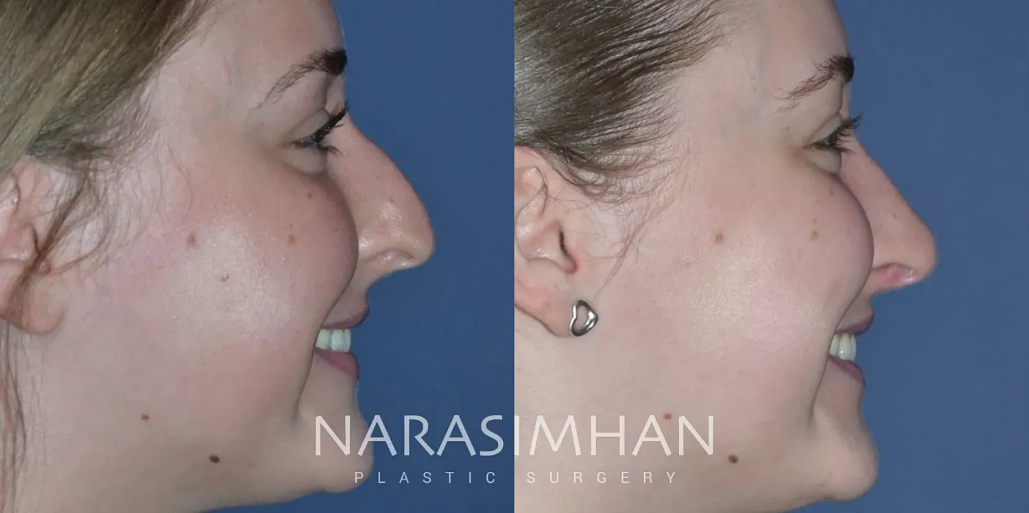 Rhinoplasty Before & After