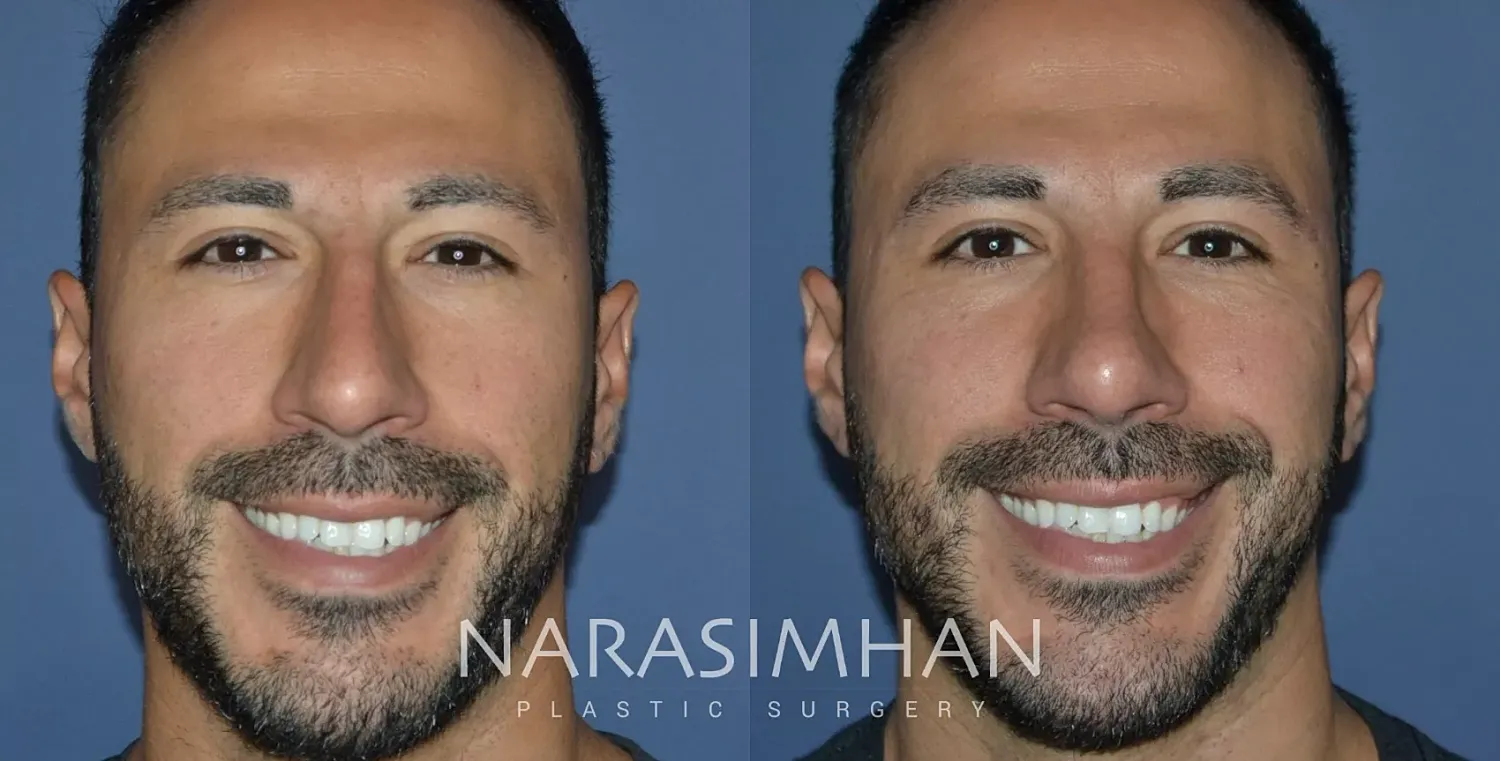 Rhinoplasty Before & After