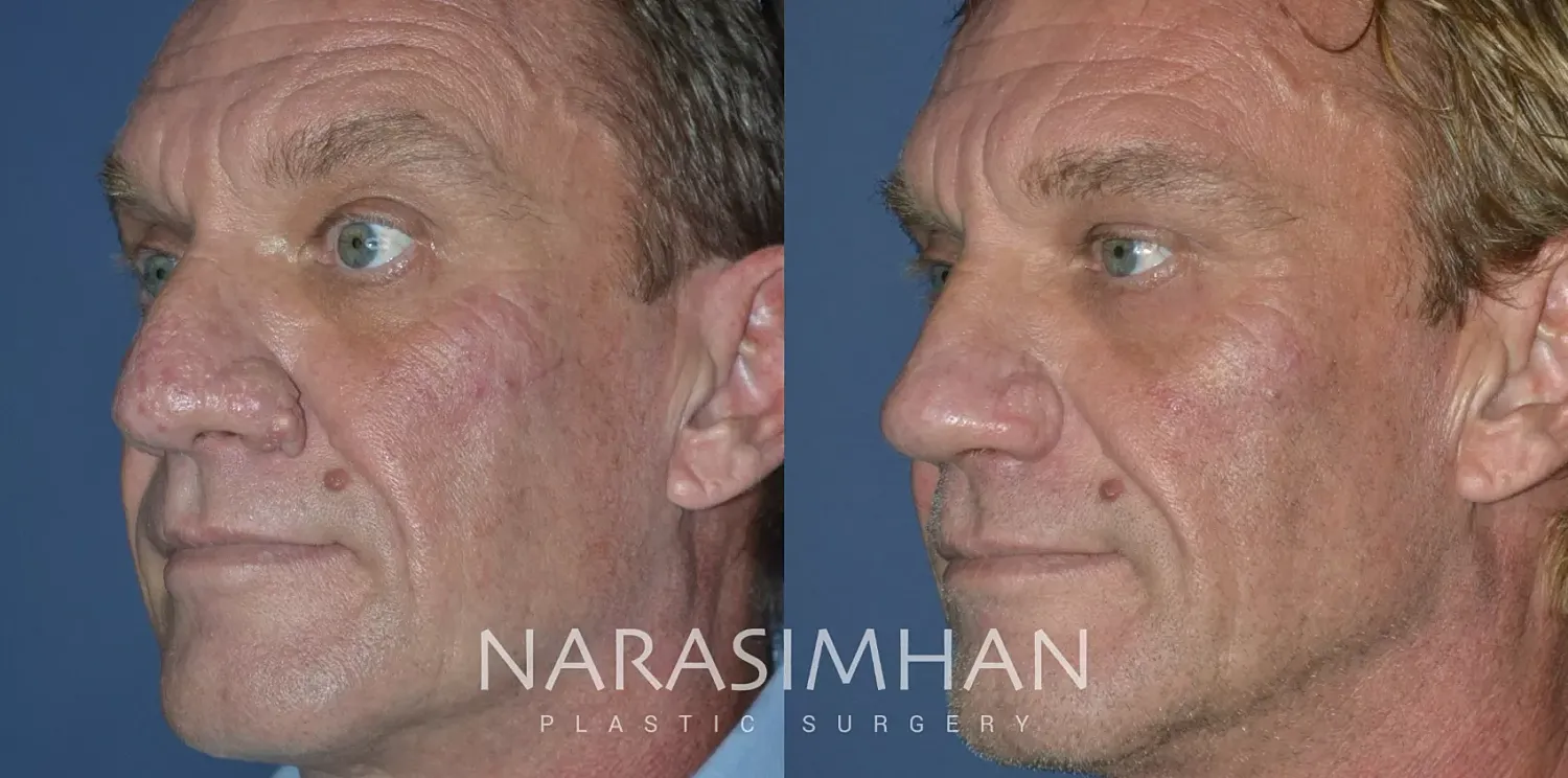 Rhinoplasty Before & After