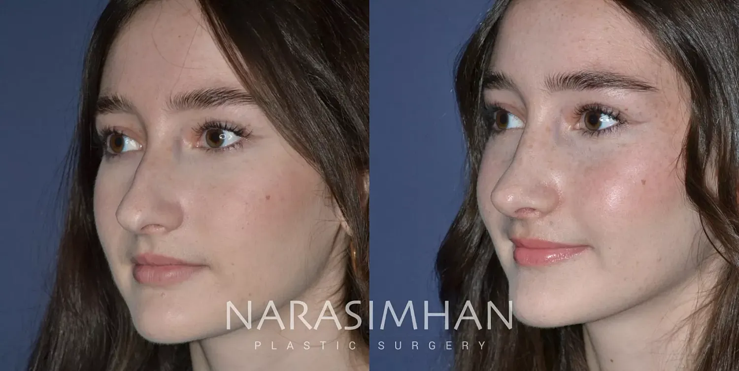Rhinoplasty Before & After