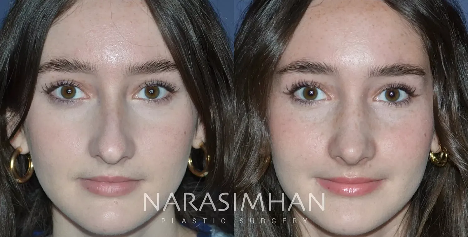 Rhinoplasty Before & After