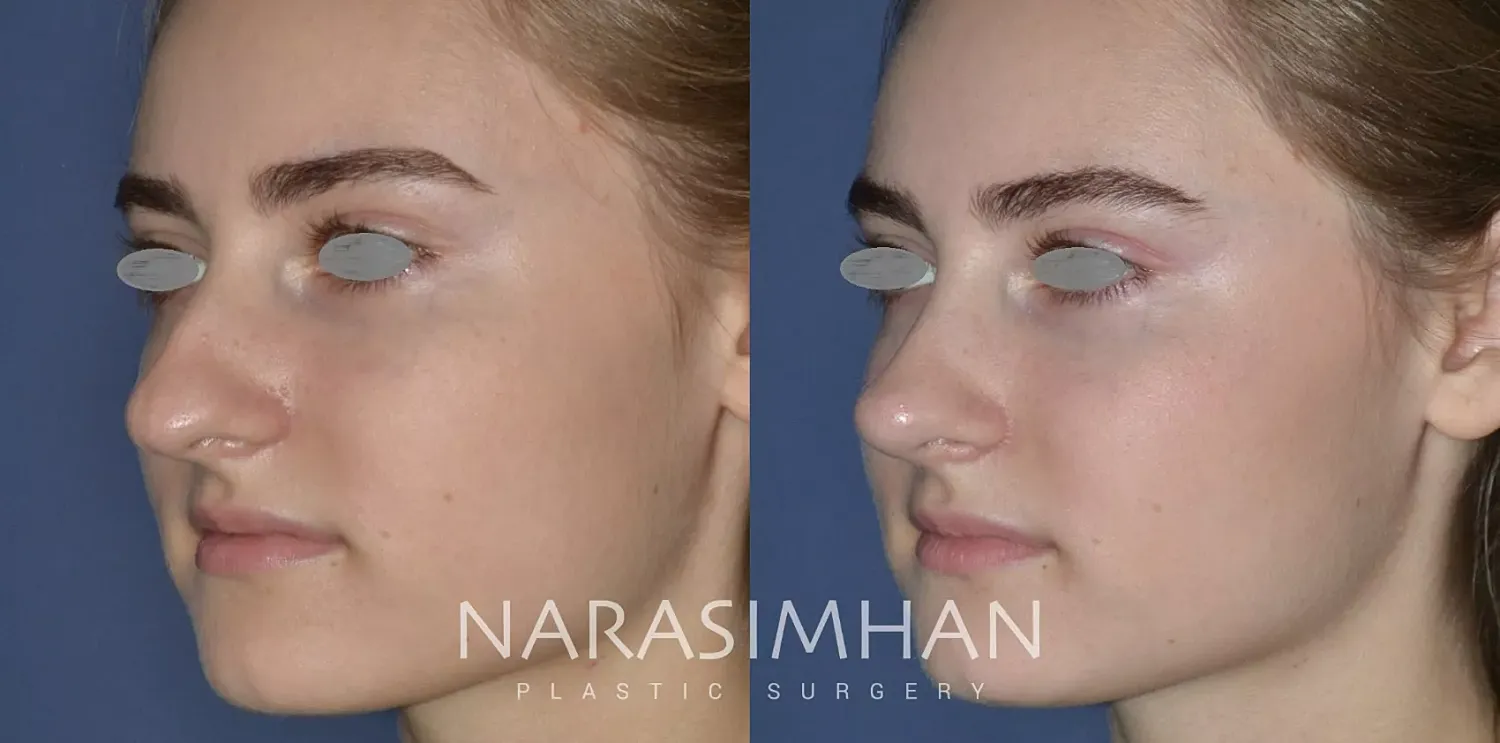 Rhinoplasty Before & After