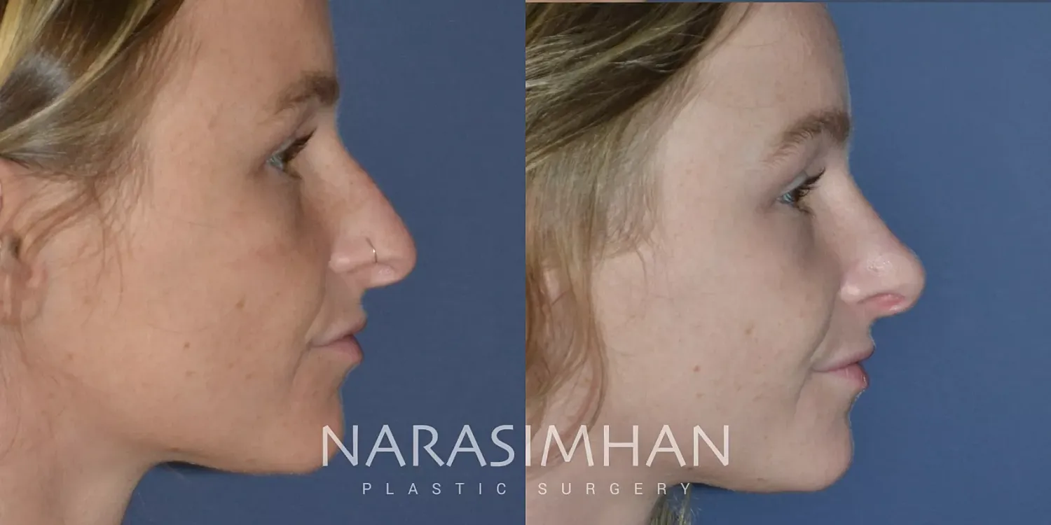 Rhinoplasty Before & After