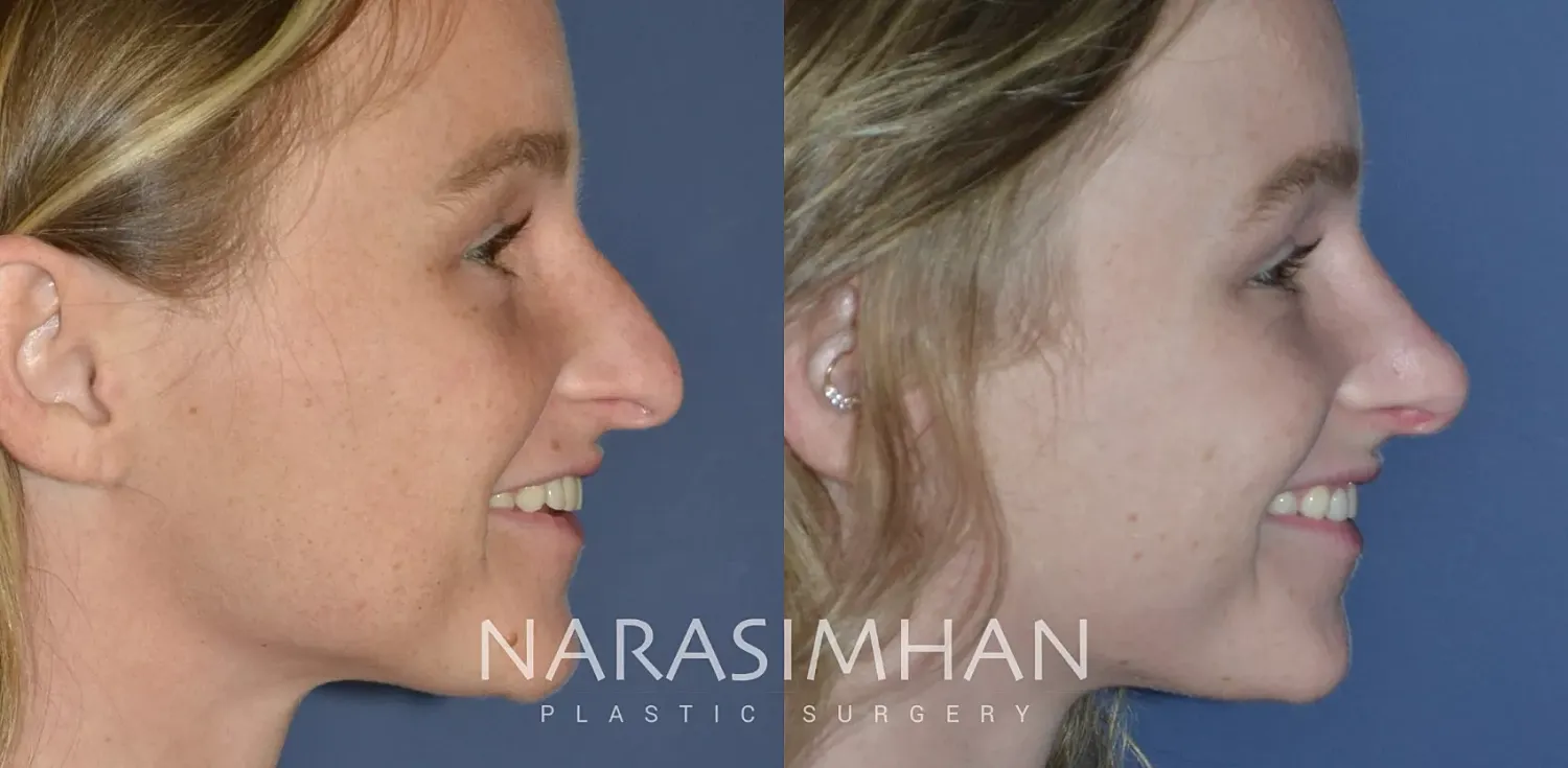 Rhinoplasty Before & After