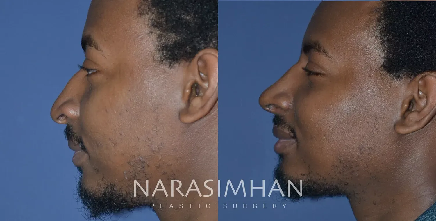 Rhinoplasty Before & After