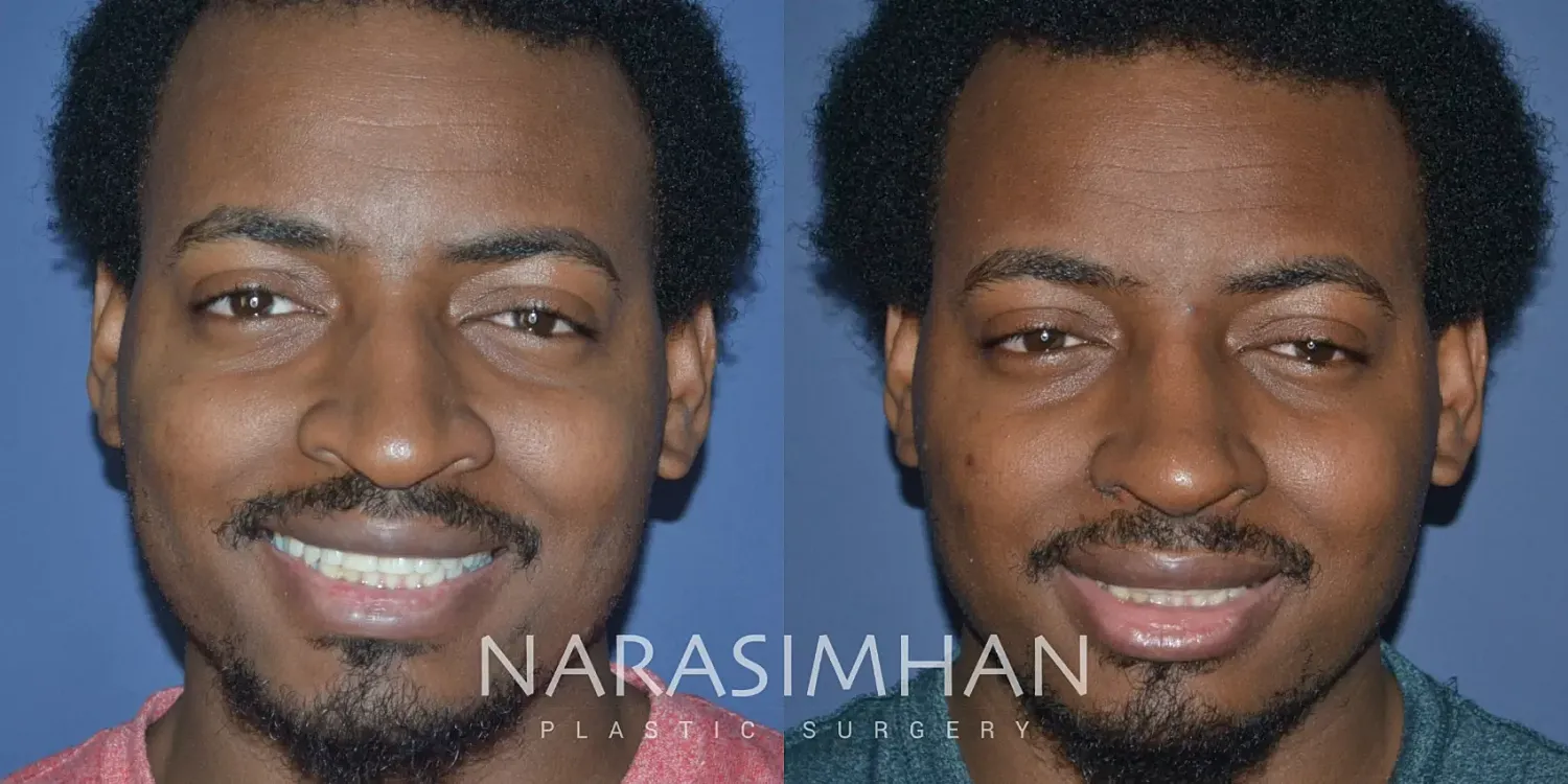 Rhinoplasty Before & After