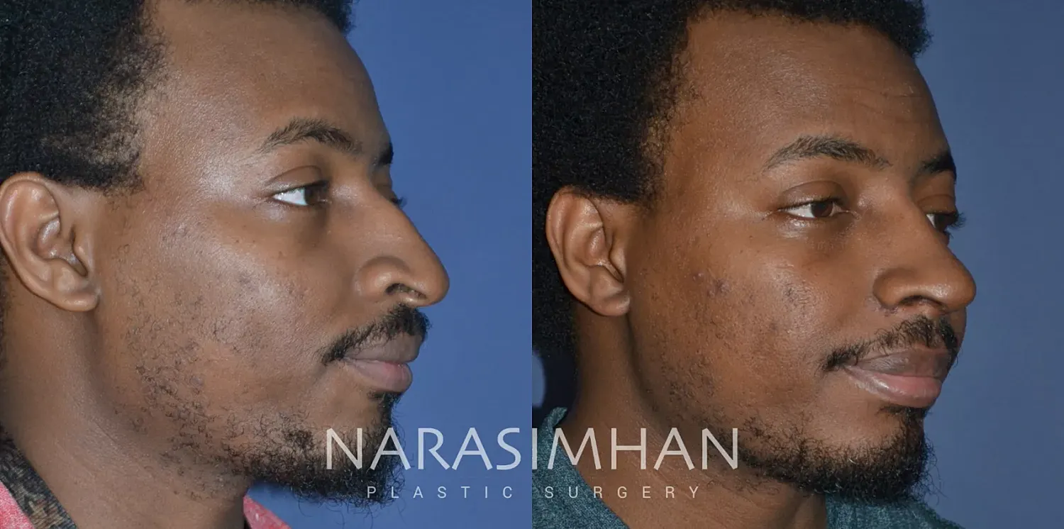 Rhinoplasty Before & After