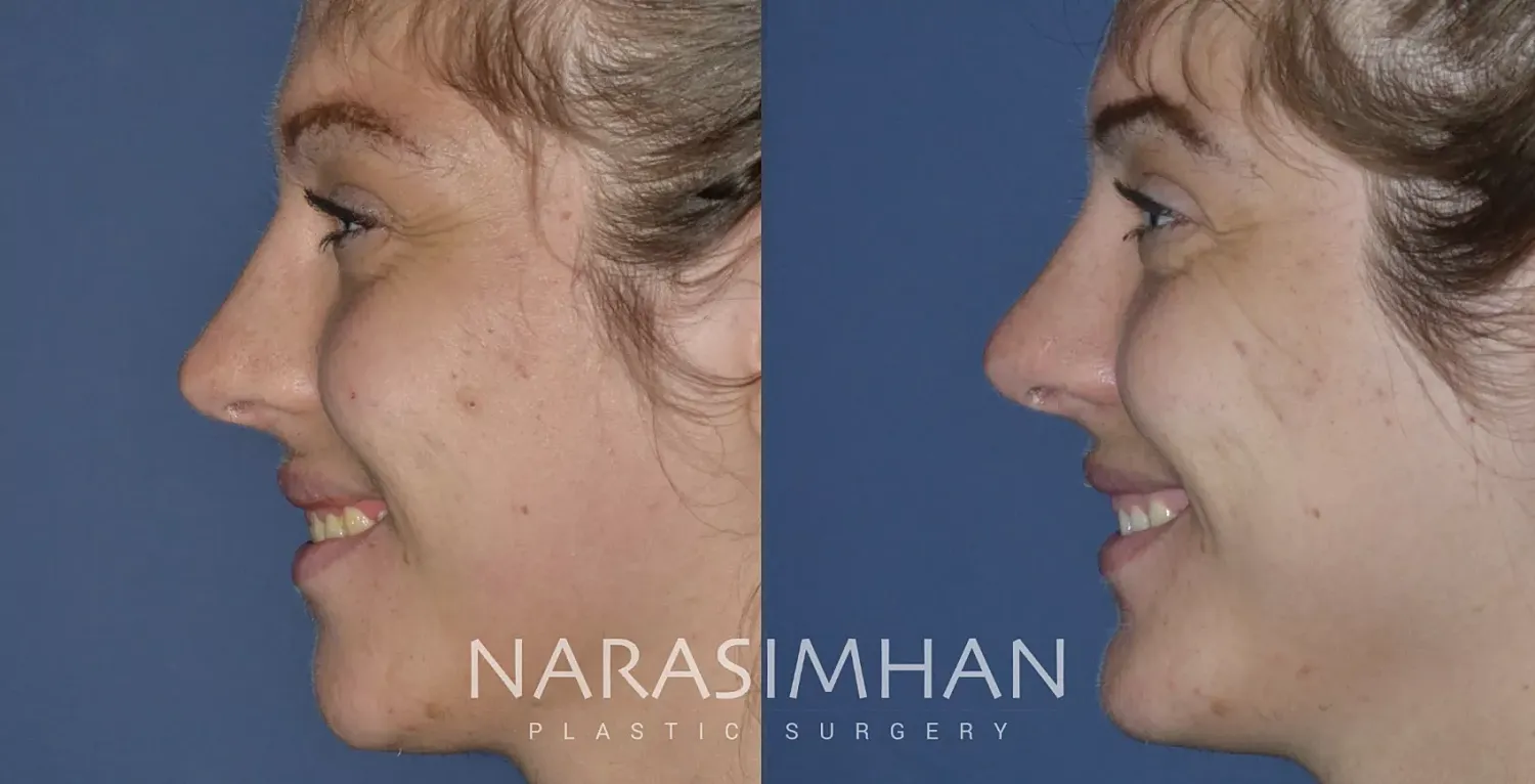 Rhinoplasty Before & After